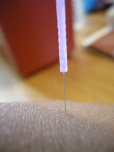 Acupuncture needle